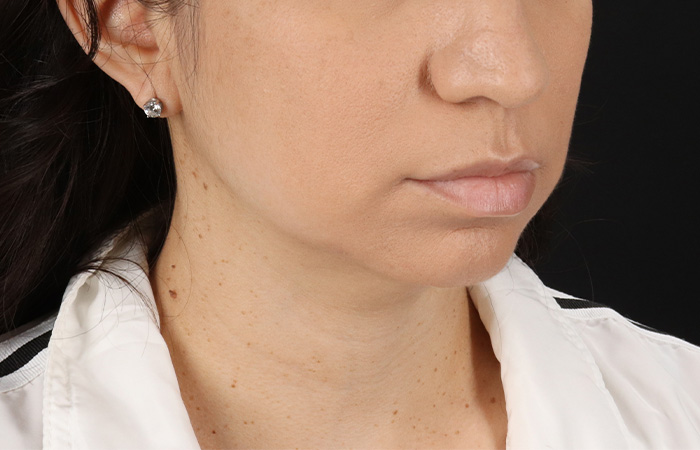 Before - right_oblique