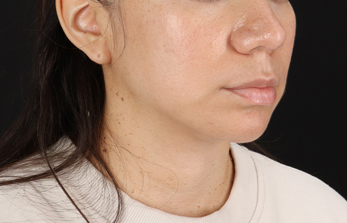 After - right_oblique