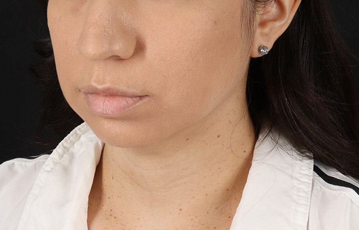 Before - left_oblique