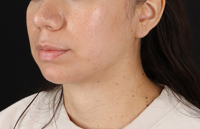 After - left_oblique