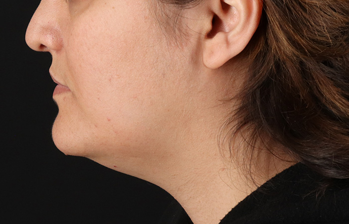 Before - left_lateral