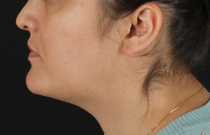 After - left_lateral