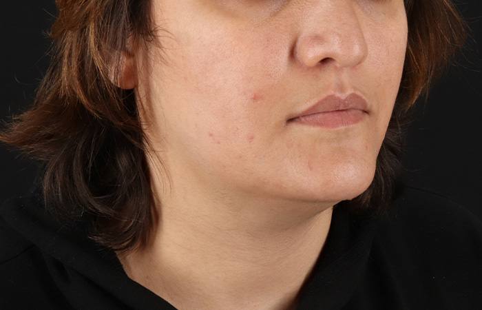 Before - right_oblique