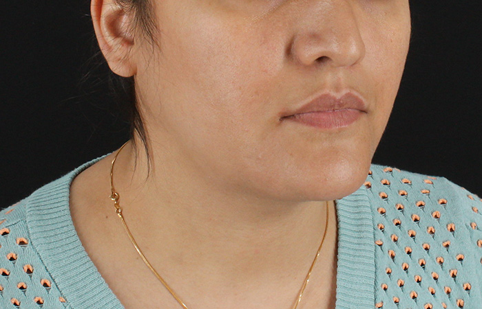 After - right_oblique