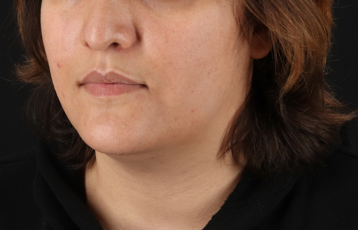 Before - left_oblique