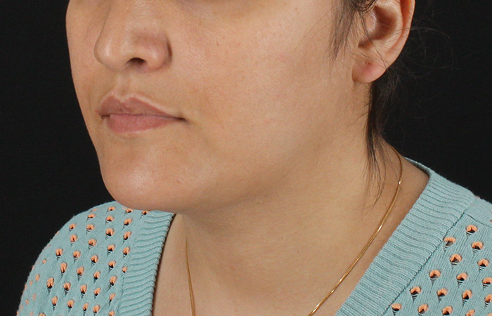 After - left_oblique