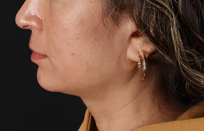 Before - left_lateral