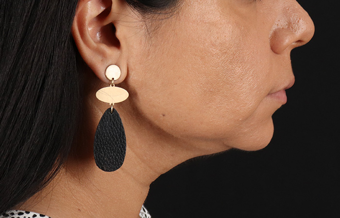 Before - right_lateral