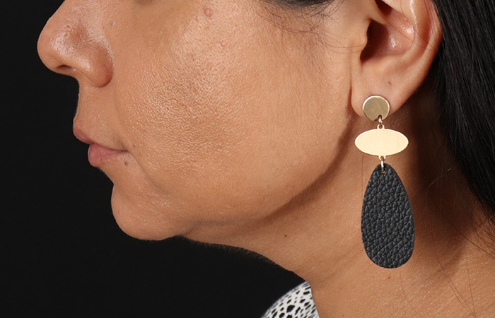 Before - left_lateral