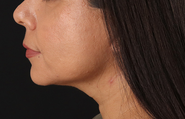 After - left_lateral