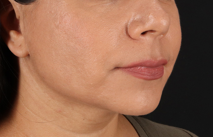 After - right_oblique