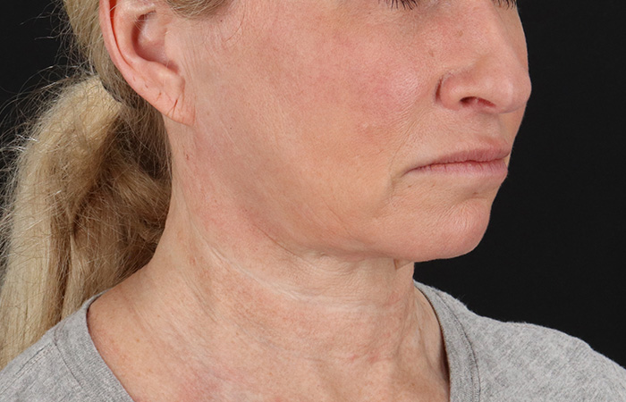 Before - right_oblique