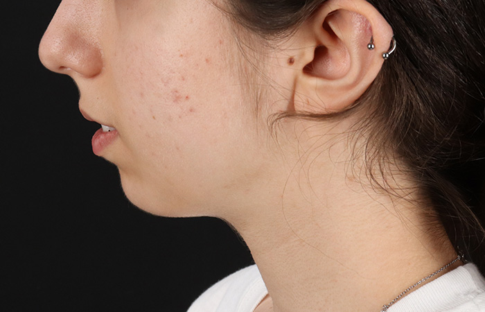 Before - left_lateral