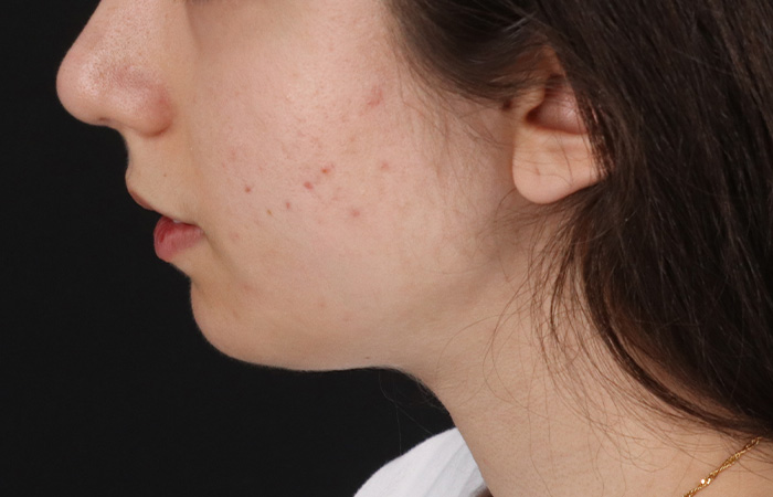 After - left_lateral