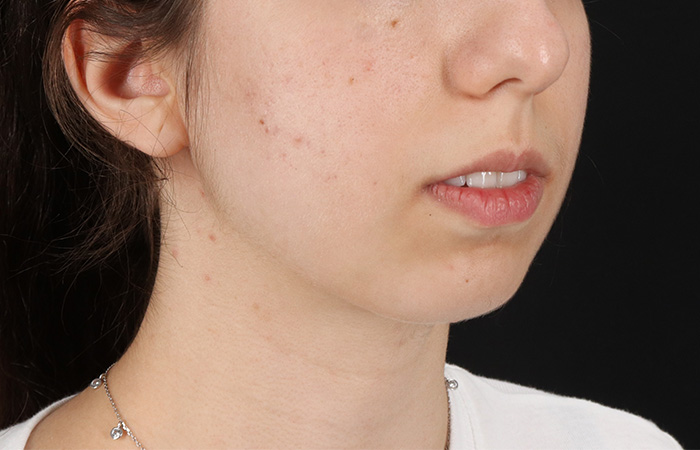 Before - right_oblique