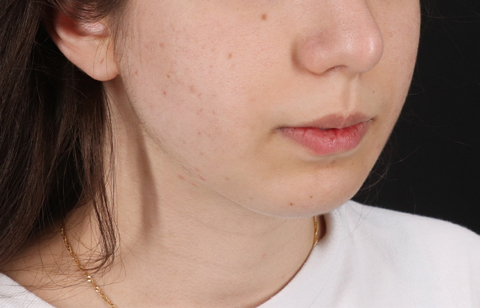 After - right_oblique