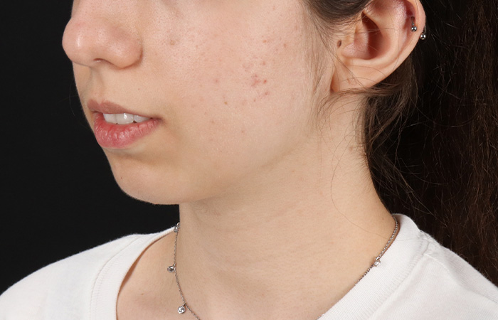 Before - left_oblique