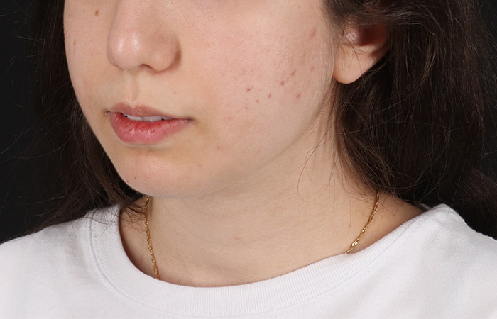 After - left_oblique