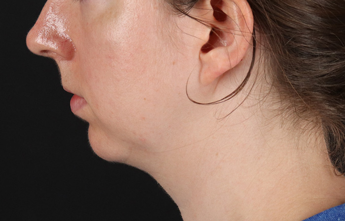 Before - left_lateral