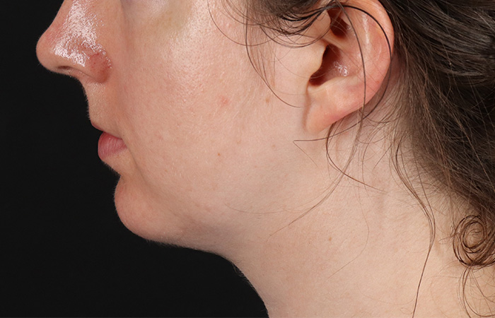 After - left_lateral