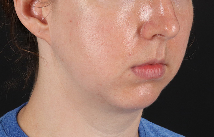 Before - right_oblique