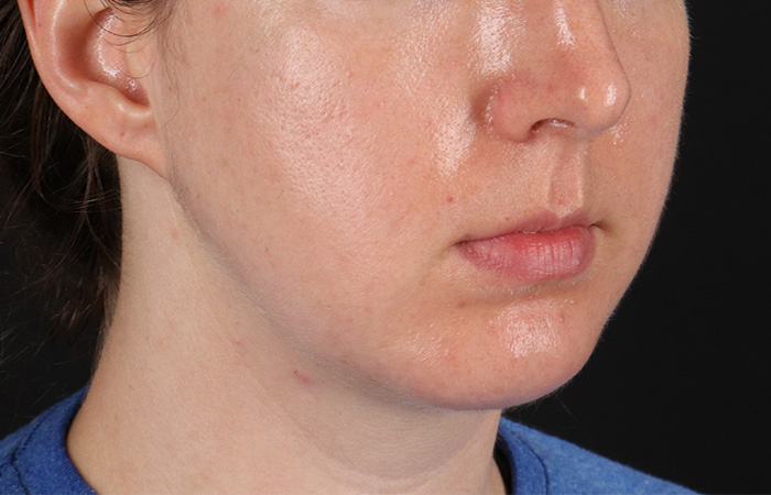 After - right_oblique