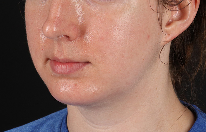 After - left_oblique