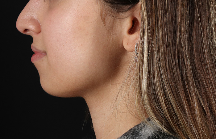 Before - left_lateral