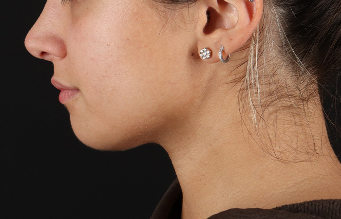 After - left_lateral