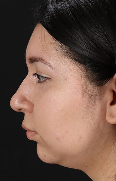 Before - left_lateral