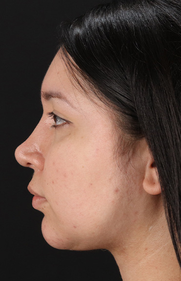 After - left_lateral