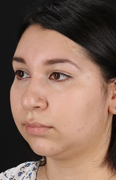 Before - left_oblique