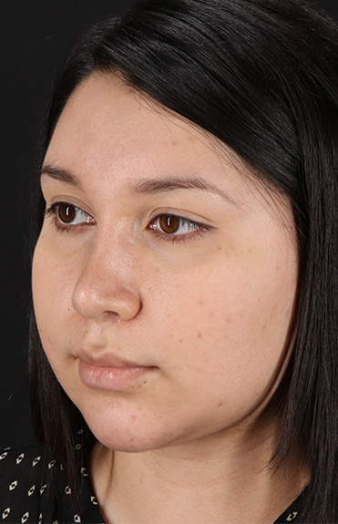 After - left_oblique