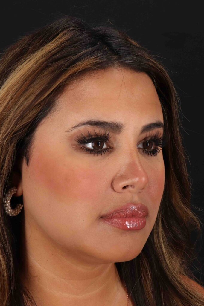 After - right_oblique