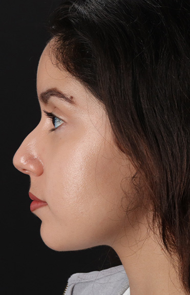 Before - left_lateral