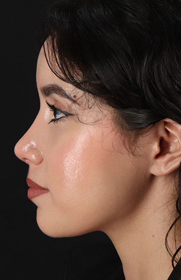 After - left_lateral