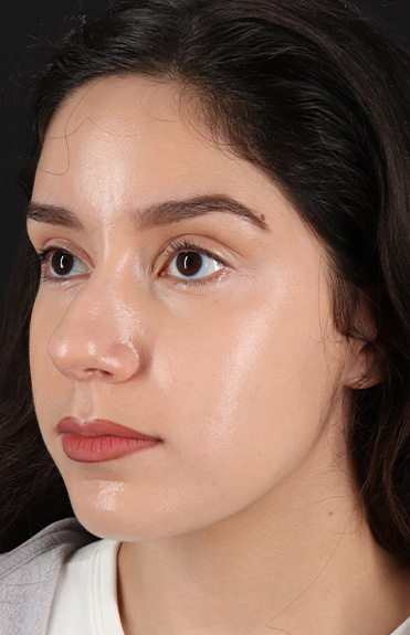 Before - left_oblique