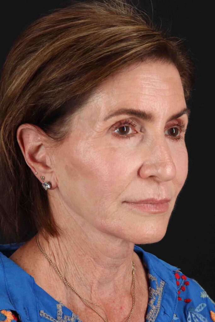 Before - right_oblique