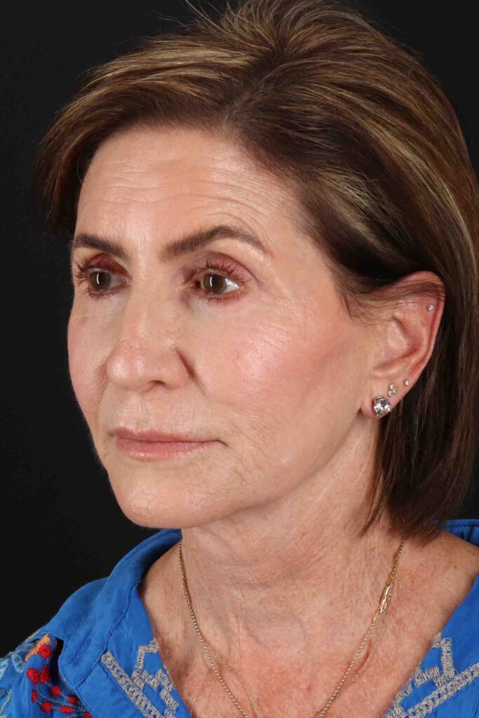 Before - left_oblique