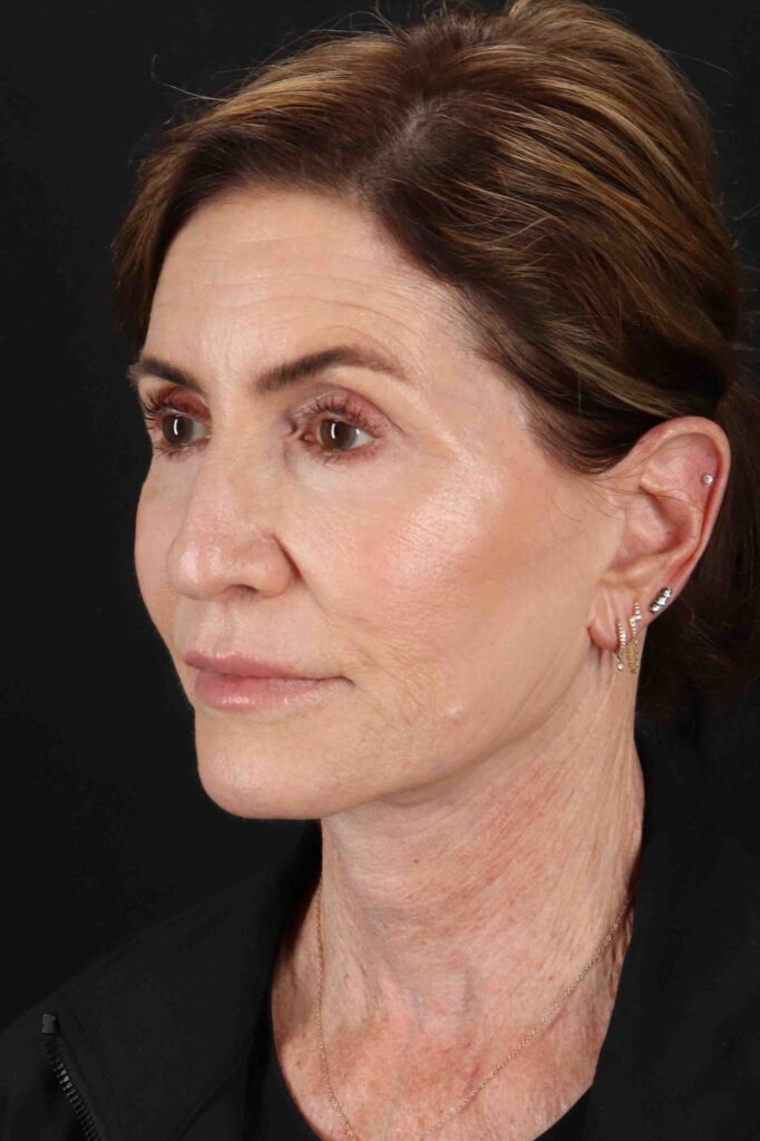 After - left_oblique