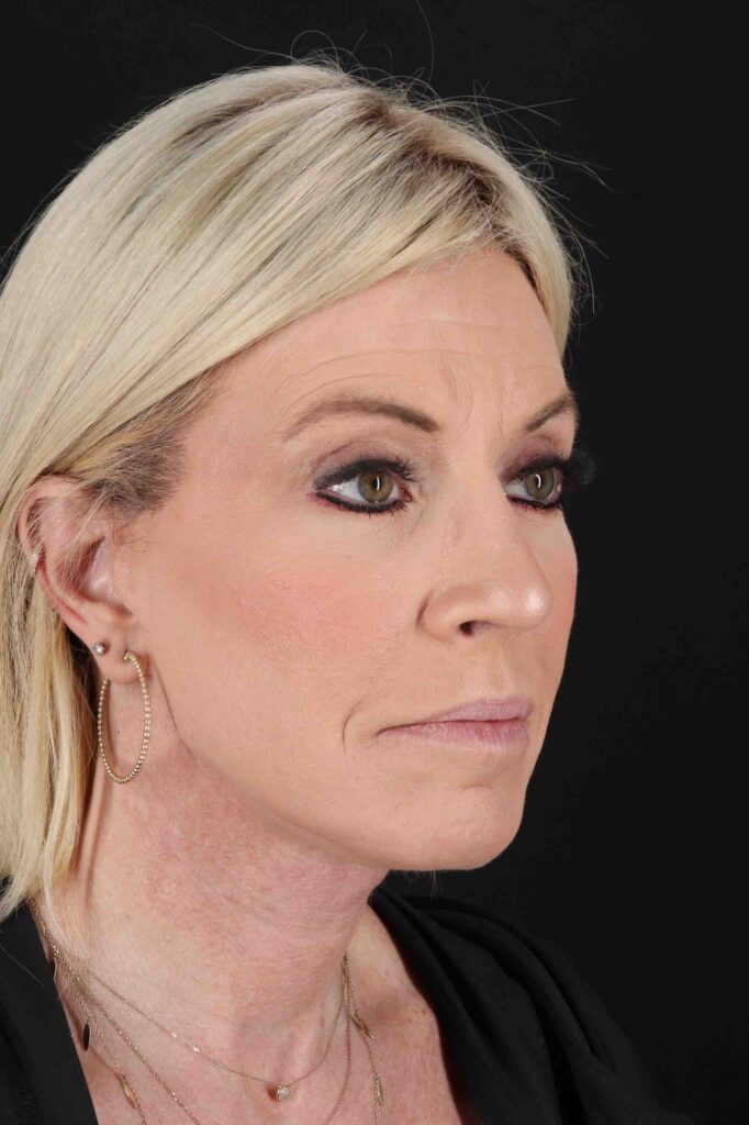 After - right_oblique