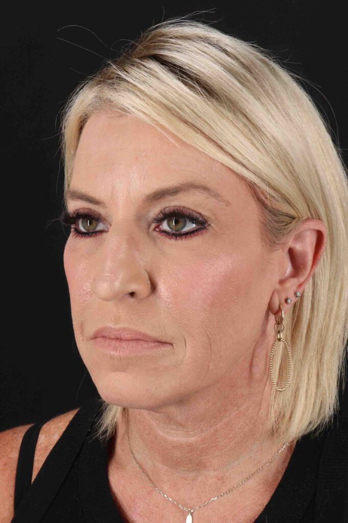 Before - left_oblique