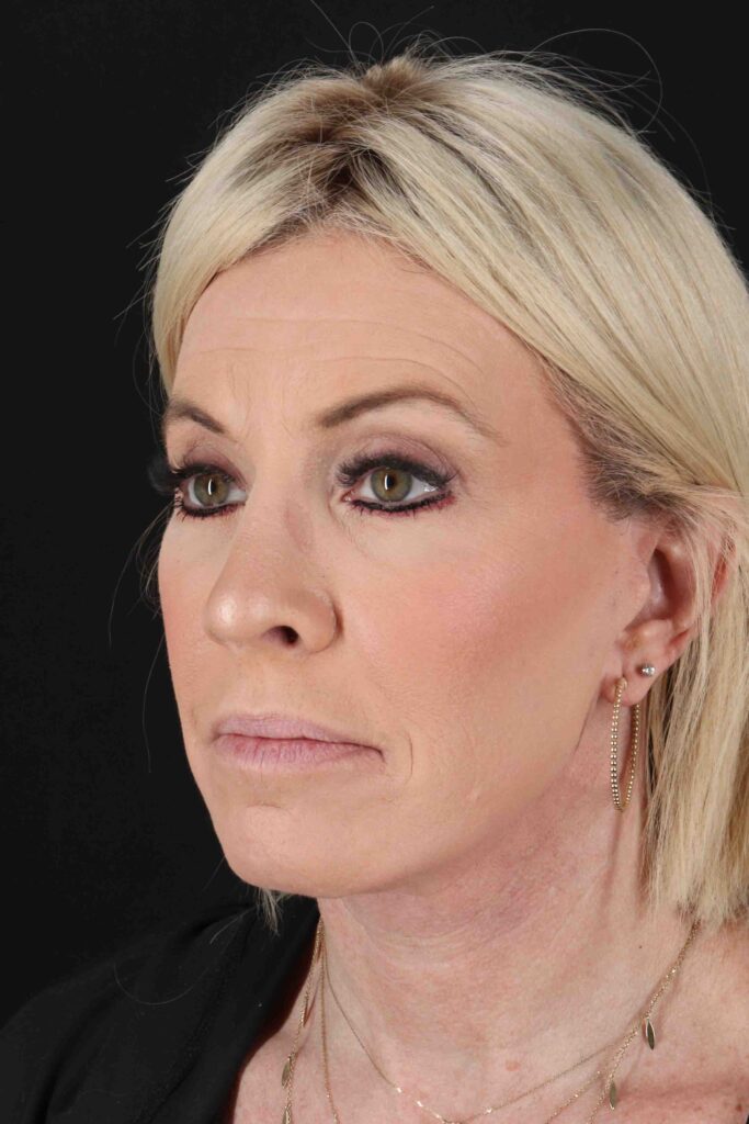 After - left_oblique