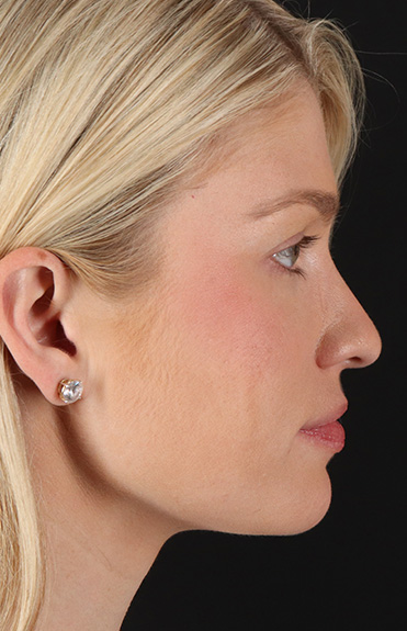 Before - right_lateral