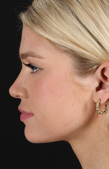 After - left_lateral