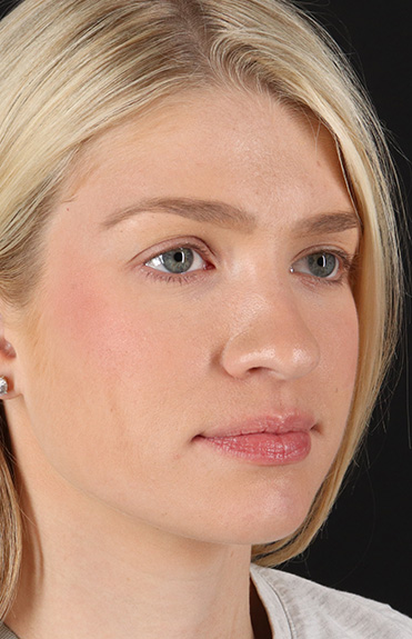 Before - right_oblique