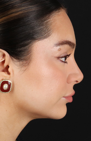 After - right_lateral