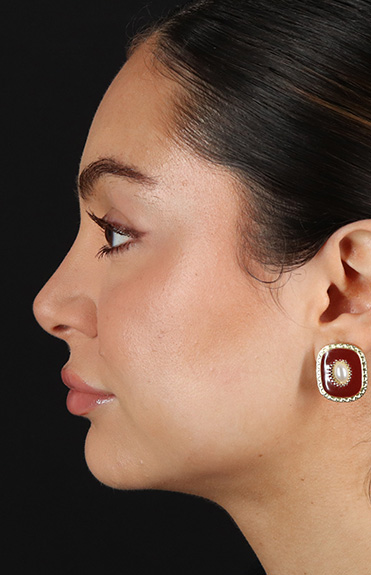 After - left_lateral