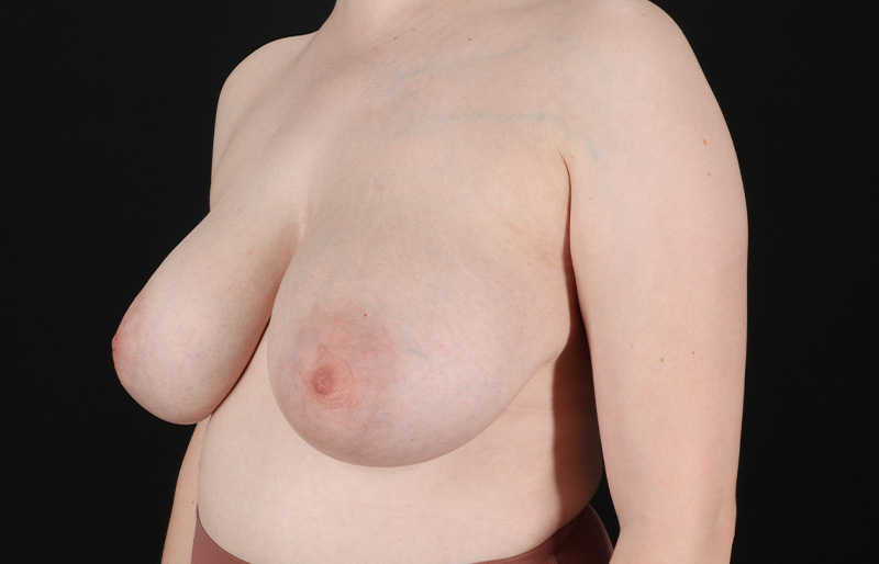 Before - left_oblique