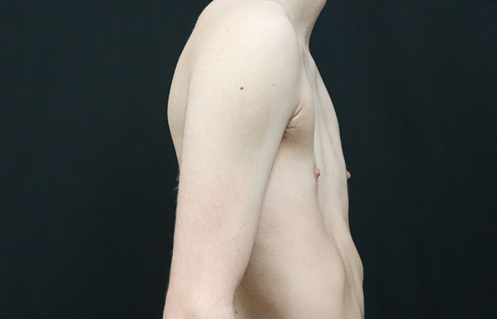 After - right_lateral